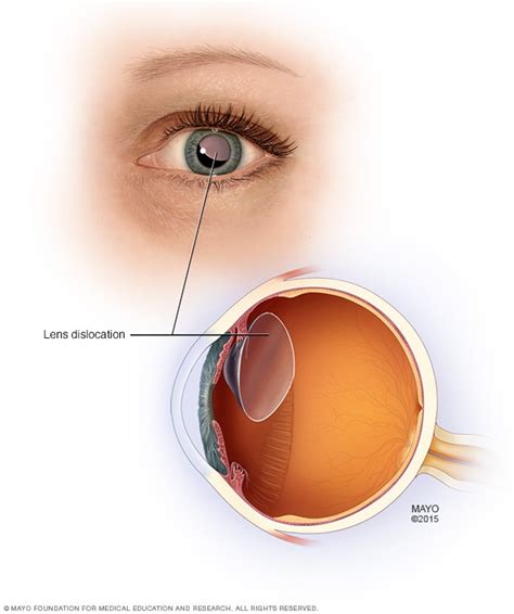 Lens Dislocation Mayo Clinic