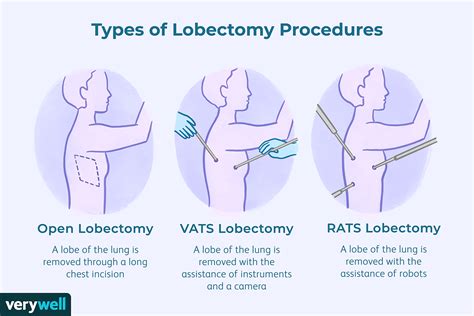 Lobectomy Lung Surgery