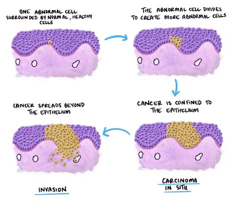 Carcinoma in situ (CIS) | MyPathologyReport