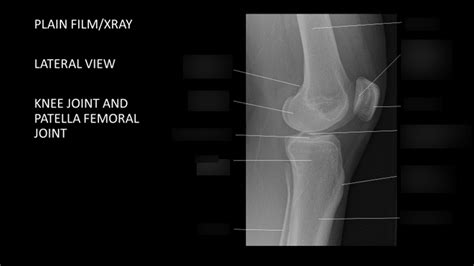 The Knee Joint Imaging Lateral View Diagram Quizlet