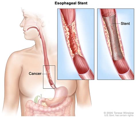 Oesophageal Cancer - MR YAHYA AL-HABBAL