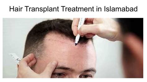 PPT Hair Transplant Treatment In Islamabad PowerPoint Presentation