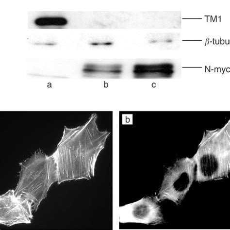 TM1 Expression Is Downregulated In More Malignant Neuroblastomas A