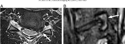 Comparison Of Mri Grading For Cervical Neural Foraminal Stenosis Based