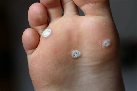 Wart On Side Of Foot Flash Sales Emergencydentistry