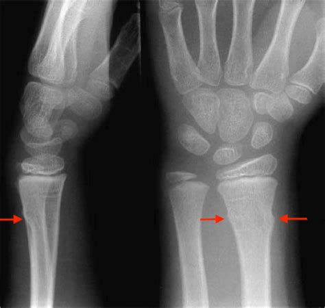 [figure Buckle Fracture Of Distal Radius Contributed By Ajay Asokan Mbbs ] Statpearls Ncbi