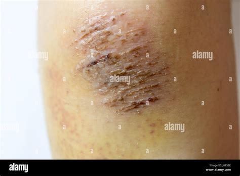 Closed up of red scab injury on woman knee background Stock Photo - Alamy