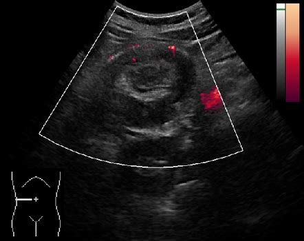 Colocolic Intussusception Due To Mucinous Carcinoma Of The Colon