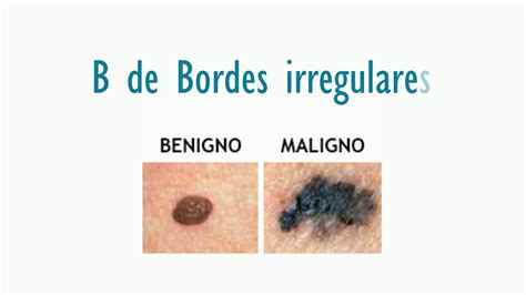 El Abcde Del Melanoma Youtube