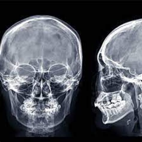 Xray Of Skull AP LAT Test 1S Pharma Xonline