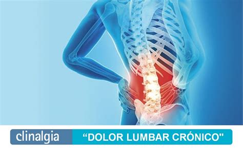 Dolor Lumbar Cronico Cl Nica Del Dolor En Murcia