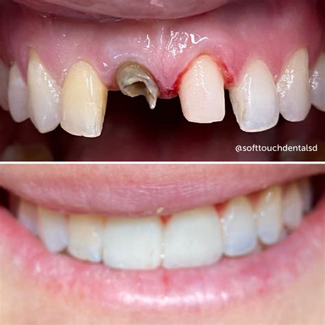 Hypodontia Before And After