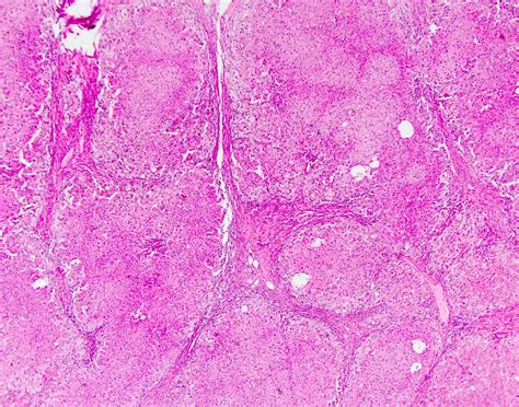 Primary Sclerosing Cholangitis Histology