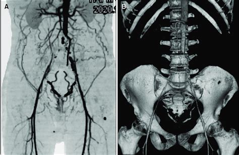 A Preoperative Computed Tomography Angiography Cta Showed Extensive