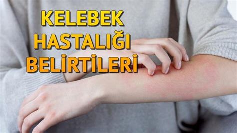 Kelebek hastalığı Lupus nedir belirtileri nelerdir Kelebek