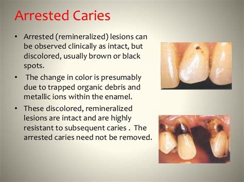 Detection And Diagnosis Of Dental Caries