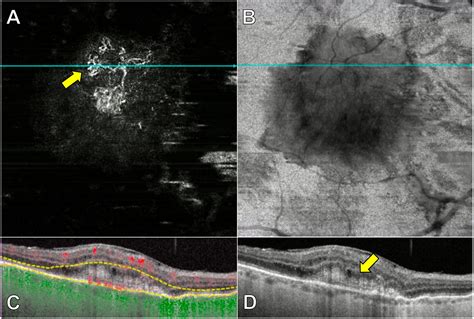 Moran CORE | OCT Angiography Imaging of Macular Neovascularization in AMD