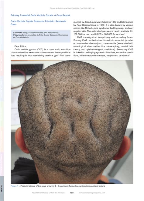 Pdf Primary Essential Cutis Verticis Gyrata A Case Report