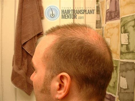 Hair Transplant Results After 2 Months