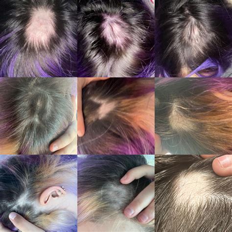 Alopecia regrowth/hair loss journey : r/alopecia_areata