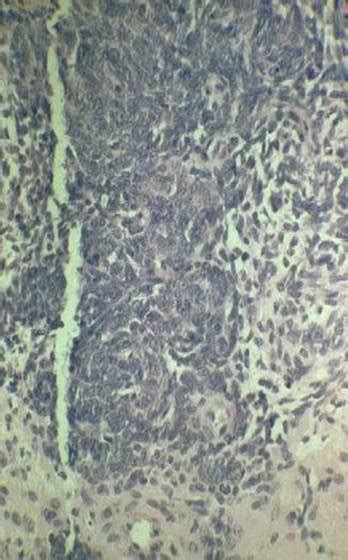 Synovial Sarcoma - Pathology - Orthobullets