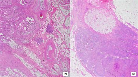 A Invasive Moderately Differentiated Adenocarcinoma With Mucinous Download Scientific Diagram