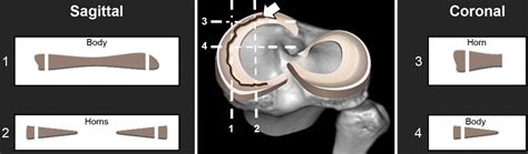 Mr Imagingbased Diagnosis And Classification Of Meniscal Tears