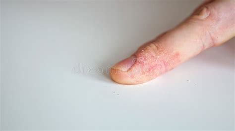 Doigts D Un Homme Atteint De Psoriasis Et D Ecz Ma Image Stock Image