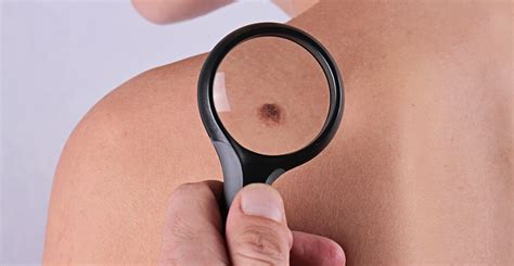 Skin Cancer Prevention Charlotte NC Steele Creek Dermatology