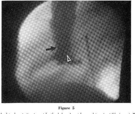 Figure 1 From Angiographic Appearance Of Idiopathic Hypertrophic