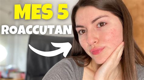 MES 5 DE ROACCUTAN ISOTRETINOINA YouTube