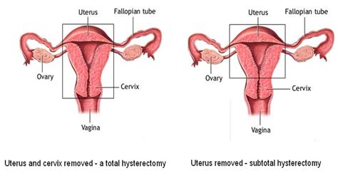 Laparoscopic Hysterectomy And Assisted Vaginal Hysterectomy Buckinghamshire Healthcare Nhs Trust