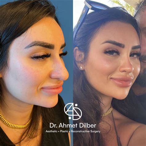 Rhinoplasty Result Dr Ahmet Dilber Nose Plastic Surgery