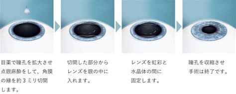 ICL | 医療法人社団 雄々会 中村眼科医院｜茨城県ひたちなか市の眼科