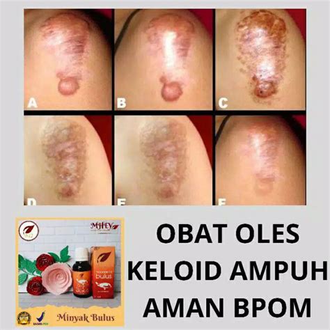 Jual Obat Keloid Ampuh Minyak Bulus Sr Asli Shopee Indonesia