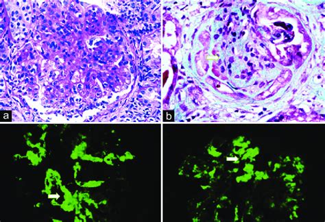 Renal Biopsy Showing Glomerular Mesangial Hypercellularity On