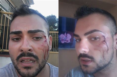 Aggressione Omofoba A Napoli Ragazzo Gay Preso A Calci E Pugni Gay It