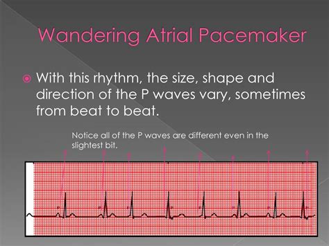 Wandering Atrial Pacemaker Ecg