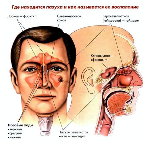 Гайморит