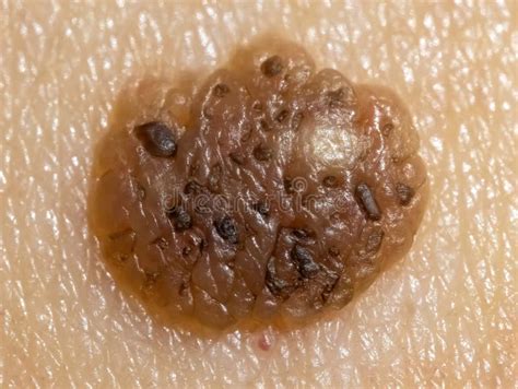 A Detailed Macro View Of A Mole With Potential Indications Of Malignant