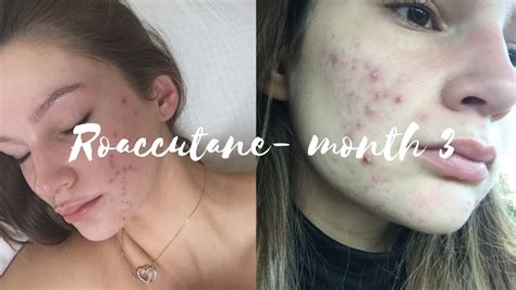 Roaccutane Daily Skin Vlog Month 3 Youtube