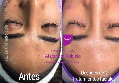 Qué es la hiperpigmentación postinflamatoria Cosmetología Ale Rabiela