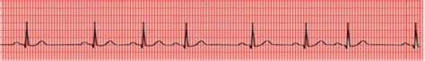 Dysrhythmias Ekg Interpretation Flashcards Quizlet