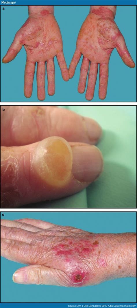 Pompholyx Clinical Features Differential Diagnosis And Management