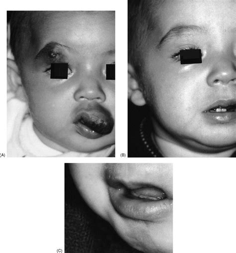 Diagnosis And Treatment Of Vascular Lesions Of The Lip British