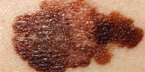 Come Prevenire I Tumori Della Pelle Il Melanoma La Dea Bendata