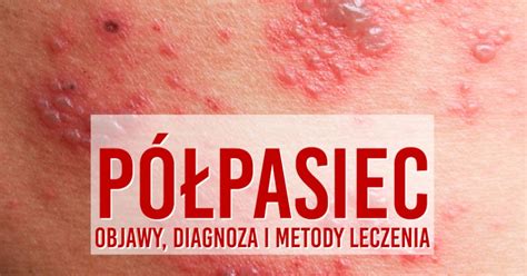 Półpasiec Objawy diagnoza i metody leczenia Centrum Medyczne PRZYJAŹNI