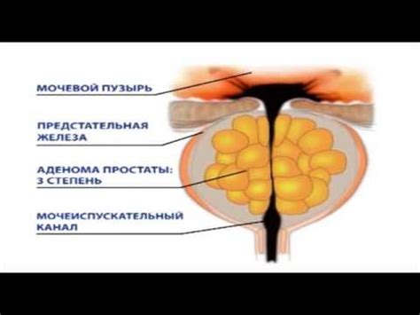 Стадии развития аденомы предстательной железы - YouTube