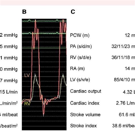 Cardiac Catheterization Before And After Pericardiocentesis Pulmonary