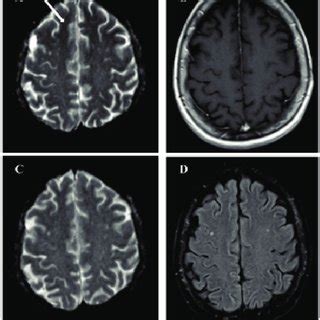 Radiological Fi Ndings Brain Magnetic Resonance Imaging Mri Diff